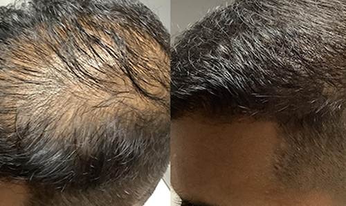 hair loss restoration non surgical mississauga oakville before after